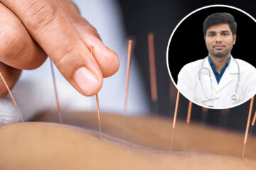 আকুপাংচার চীনের প্রাচীন চিকিৎসা